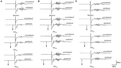 Elucidation of the mechanism underlying impaired sensorimotor gating in patients with primary blepharospasm using prepulse inhibition